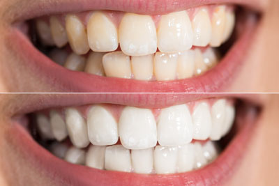 Teeth Whitening: A Cosmetic Dentist Explains the Basics